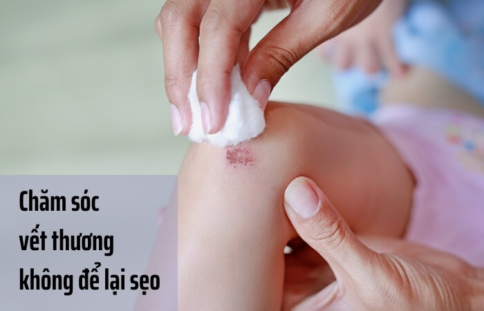 Cách Chăm Sóc Vết Thương để Hạn Chế Sẹo